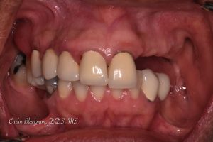 Before the denture procedure | Guided Smiles Prosthodontics and Implant Center