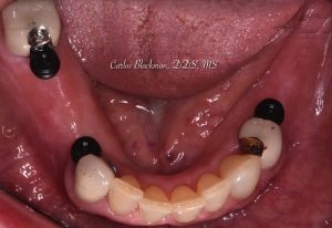 Denture procedure in Ponte Vedra, FL | Guided Smiles Prosthodontics and Implant Center