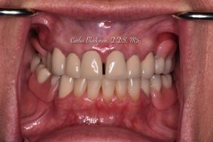 Denture picture 2in in Ponte Vedra, FL | Guided Smiles Prosthodontics and Implant Center