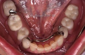 Denture picture 1 in in Ponte Vedra, FL | Guided Smiles Prosthodontics and Implant Center