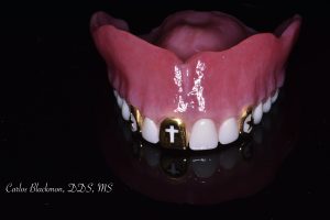 From view of denture by Dr. Carlos Blackmon | Guided Smiles Prosthodontics and Implant Center