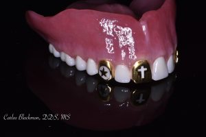 Denture by Dr. Carlos Blackmon | Guided Smiles Prosthodontics and Implant Center