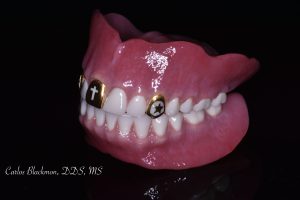 Dentures in in Ponte Vedra, FL | Guided Smiles Prosthodontics and Implant Center