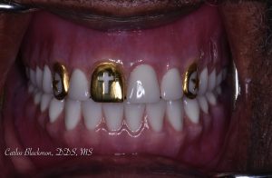 After Denture | Guided Smiles Prosthodontics and Implant Center
