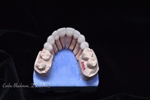 Dental Crowns inside view in Ponte Vedra, FL | Guided Smiles Prosthodontics and Implant Center