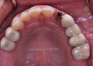 Preparing for Dental Implants | Guided Smiles Prosthodontics and Implant Center