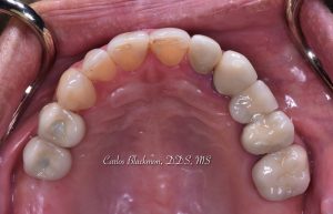Dental implants in Ponte Vedra, FL | Guided Smiles Prosthodontics and Implant Center