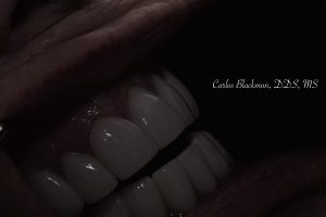 Dental crowns by Dr. Carlos Blackmon, DDS, MS | Guided Smiles Prosthodontics and Implant Center