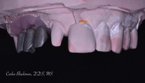 3D view of Dental Implants | Guided Smiles Prosthodontics and Implant Center