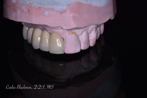 Molded Dental Implants in Ponte Vedra, FL | Guided Smiles Prosthodontics and Implant Center