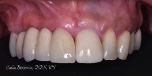 Dental implants in Ponte Vedra, FL | Guided Smiles Prosthodontics and Implant Center