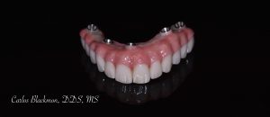 Picture of Denture in Ponte Vedra, FL | Guided Smiles Prosthodontics and Implant Center