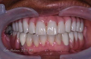 After the denture has been completed | Guided Smiles Prosthodontics and Implant Center