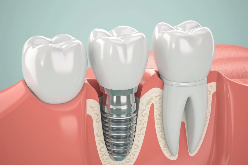 Are Dental Implants Right for Me