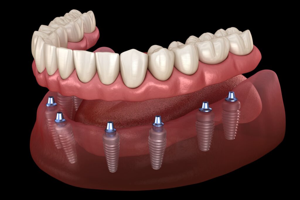 Why Should You Consider Implant-Supported Dentures?